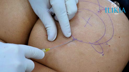 Aumento de glúteos com macromoléculas de ácido hialurônico (UP Max)