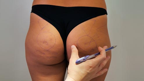 Evolução de aumento de glúteos com HA e hidroxiapatita de cálcio (STIIM)