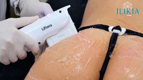 Sustentação glútea com HIFU + macromoléculas de ácido hialurônico