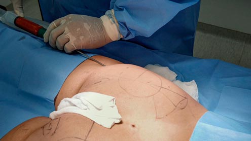 Aumento de glúteos com lipoenxertia, PRP e macromoléculas de ácido hialurônico